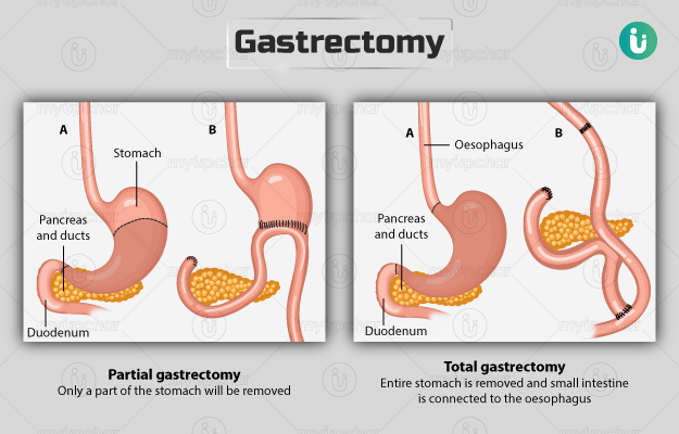 gastrectomy-procedure-purpose-results-cost-price-in-hindi.png